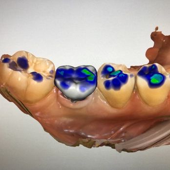 Randall I Hashimoto, DDS - My custom designed crown!!! So exciting - General Dentistry Near Me - Fremont, California Randall I Hashimoto, DDS - My custom designed crown!!! So exciting - General Dentistry Near Me - Fremont, California