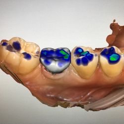 Randall I Hashimoto, DDS - My custom designed crown!!! So exciting