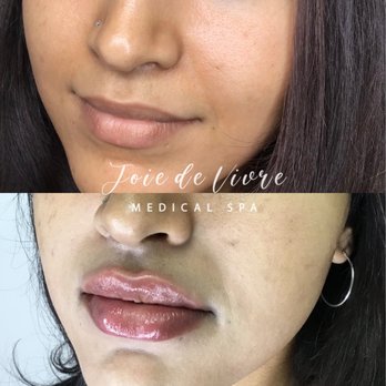 Joie De Vivre - Lip filler@ jdvmedspa - Medical Spas Near Me - Canton, Ohio