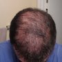 La Mesa Medical Hair Restoration