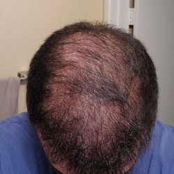 La Mesa Medical Hair Restoration - 2 years post op. Noticeable increase in density around the hairline both front and sides. Good stuff!