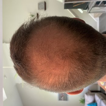 RESTORE Hair - Day 0 - Before - Hair Loss Centers Near Me - Oak Brook, Illinois RESTORE Hair - Day 0 - Before - Hair Loss Centers Near Me - Oak Brook, Illinois
