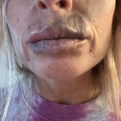 Quality Healthcare & Wellness Center - Bruising