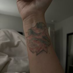 ExcelLase - After five treatments