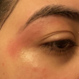 Eyelid was burnt with waxed or too much wax and damaged skin