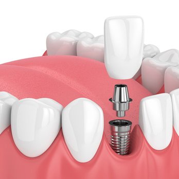 A Mile of Smiles - Implant dentistry - General Dentistry Near Me - Brick, New Jersey A Mile of Smiles - Implant dentistry - General Dentistry Near Me - Brick, New Jersey