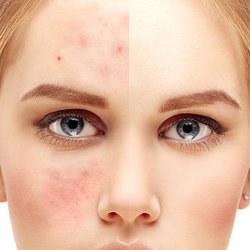 Remarkably Radiant Skincare - Acne Scar Treatment