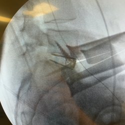 Todd Pitts, MD - Screws in my back