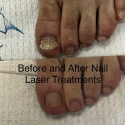 Michael R. Cook, Podiatry - Before and after nail laser treatments