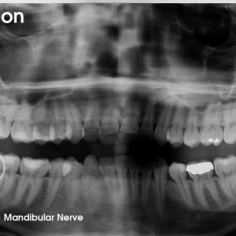 Sharad Sohoni, DDS - Panoramic x-ray prior to wisdom teeth extraction. Notice how the impacted wisdom tooth is so close to the nerve canal. - Oral Surgeons Near Me - Mountain View, California Sharad Sohoni, DDS - Panoramic x-ray prior to wisdom teeth extraction. Notice how the impacted wisdom tooth is so close to the nerve canal. - Oral Surgeons Near Me - Mountain View, California