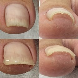 Sassy Nail Art by Kelly Kalua - Ingrown toenail care