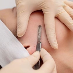 Anita’s Skin Care Clinic - Got peach fuzz but you do not feel like getting waxed or threaded? Book in for a Dermaplaning Treatment instead :)