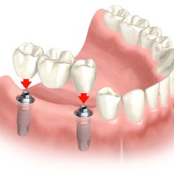 California Dental Group - Bridge over Implants