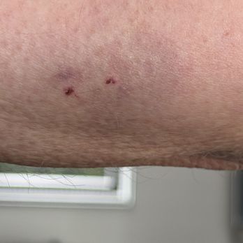 Quality Inn Jonesville I-77 - snake bite healing -arm still mottled - Hotels Near Me - Jonesville, North Carolina Quality Inn Jonesville I-77 - snake bite healing -arm still mottled - Hotels Near Me - Jonesville, North Carolina