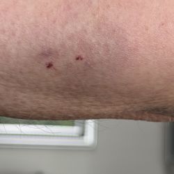 Quality Inn Jonesville I-77 - Snake bite healing -arm still mottled