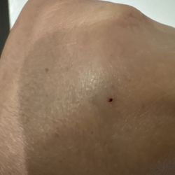 Restore Hyper Wellness - Here is the shot she gave me .She can't find the vein