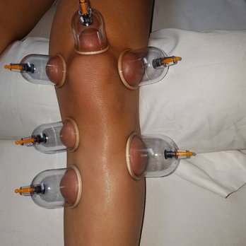 You Acupuncture - Cupping to promote circulation on this soccer player's knee. - Acupuncture Near Me - Cooper City, Florida You Acupuncture - Cupping to promote circulation on this soccer player's knee. - Acupuncture Near Me - Cooper City, Florida