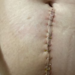 Wasatch Neurosurgery and Spine Associates - My very swollen abdomen after the finished my second fusion!!