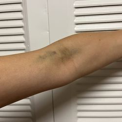 Chesterfield Family Practice Center PC - I got bruised up from getting labs drawn a few days ago. This has never happened to me before. The needle went in hard and surprised me.