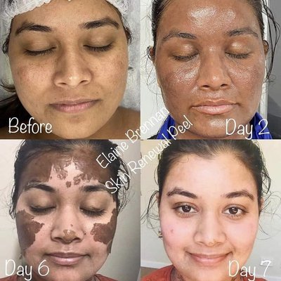 Elaine Brennan Skin Renewal Peel - This is a safe and effective peel that addresses multiple skin conditions such as acne, hyperpigmentation, melasma, ingrown hairs, texture, fine lines and wrinkles and boosts collagen and elastin production over the next 2-3 months post peel. It is considered best effective if 2 initial peelings done 6-8 weeks apart depending on skin's needs and conditions.