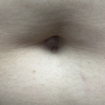 Southwest WomanCare OBGYN - Tummy pokes scar - Obstetricians & Gynecologists Near Me - Houston, Texas Southwest WomanCare OBGYN - Tummy pokes scar - Obstetricians & Gynecologists Near Me - Houston, Texas