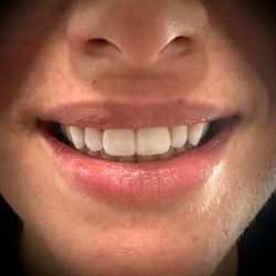 Sygma Dental - "No-prep" Composite Resin Veneers for Diastema Space Closures between upper front teeth. A healthy vibrant smile is contagious.