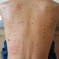 Aloha Allergy and Immunology - Multi-Prick Testing (The results after 10 minutes)
