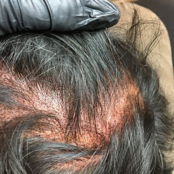 CustomScalp - Hair Loss Centers Near Me - Greenfield, Wisconsin CustomScalp - Hair Loss Centers Near Me - Greenfield, Wisconsin