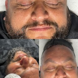 Had my first facial in my life, great experience. Had a deluxe with deep pores extraction. Black head all gone.