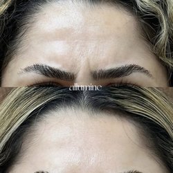 Allumine Skin Clinic - Botox