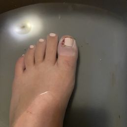 After seeing a doctor and dr removing my pretty toenail After seeing a doctor and dr removing my pretty toenail