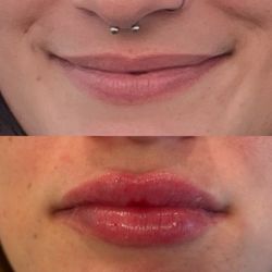 Rejuvenate Medi-Spa & Wellness - Before and immediately after filler