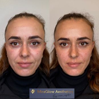 Miraglow Aesthetics - Nasolabial fold filler - Medical Spas Near Me - Los Angeles, California Miraglow Aesthetics - Nasolabial fold filler - Medical Spas Near Me - Los Angeles, California