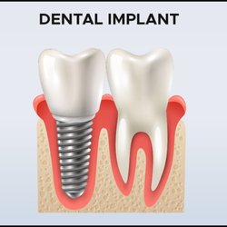 Gentle Dental - Dental Implant explained