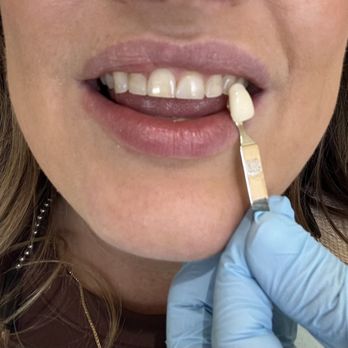 Stephen Hiroshige, DDS - PRE whitening - General Dentistry Near Me - Gardena, California