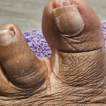 Majestic Nails - As you can see the nail is cut down to the meat - Nail Salons Near Me - Spartanburg, South Carolina Majestic Nails - As you can see the nail is cut down to the meat - Nail Salons Near Me - Spartanburg, South Carolina