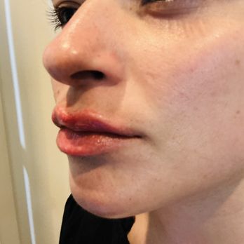 Age Management & Optimal Wellness - Best lip fillers by ya girl Elaine - Weight Loss Centers Near Me - Tampa, Florida