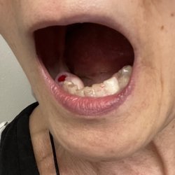 Riverbend Family Dental - This tooth was pulled