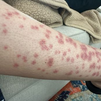 LaserAway - This is my lower leg 4 days after treatment. - Medical Spas Near Me - Las Vegas, Nevada LaserAway - This is my lower leg 4 days after treatment. - Medical Spas Near Me - Las Vegas, Nevada