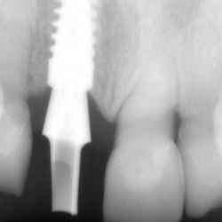 Family Dental Care - Front broken tooth replaced with implant/ abutment/ crown