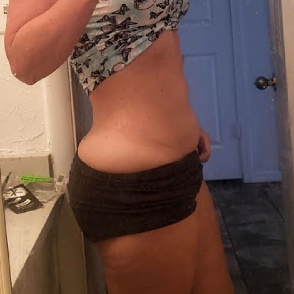 Ideal Image Tulsa - Late 2022. Weight loss has been next to impossible and my stomach isn't responsive to diet and exercise at all anymore - Laser Hair Removal Near Me - Tulsa, Oklahoma Ideal Image Tulsa - Late 2022. Weight loss has been next to impossible and my stomach isn't responsive to diet and exercise at all anymore - Laser Hair Removal Near Me - Tulsa, Oklahoma