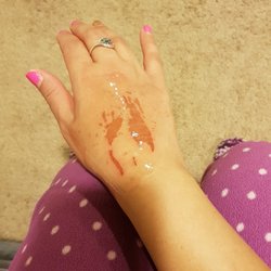 Gallery Beauty Salon - The lady waxing me at this place completely PEELED off my skin!! (I've attached a picture). I have gotten waxing done from different salons