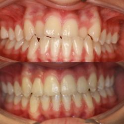 Toothworks of Bakersfield - Before and after Invisalign