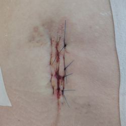 Spine Center Harborview Medical Center Uw Medicine - My back .. 2 months later and the sutures are still oozing pus.