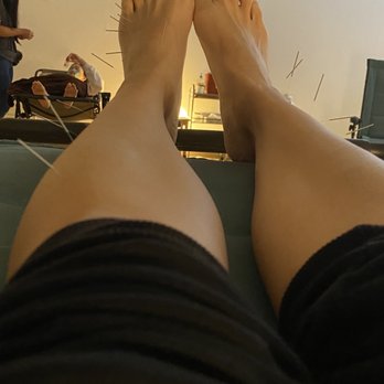 Numo Acupuncture - My 3rd treatment - Acupuncture Near Me - San Jose, California