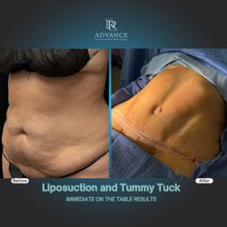 Advance Laser & Cosmetic Surgery - Tummy Tuck with Liposuction