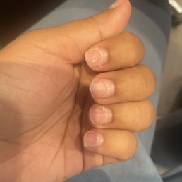 After she removed/ripped off the previous nails. My pinky nail was very damaged in the process and was slightly bleeding