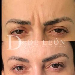 De León - Botox en entrecejo