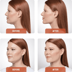 Golden Aesthetics Medspa - Kybella injections permanently dissolve fat cells in the neck and body.