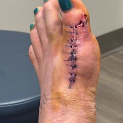 McVay Foot & Ankle - Foot after 1 week